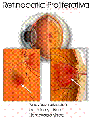 retinopatia ploriferativa